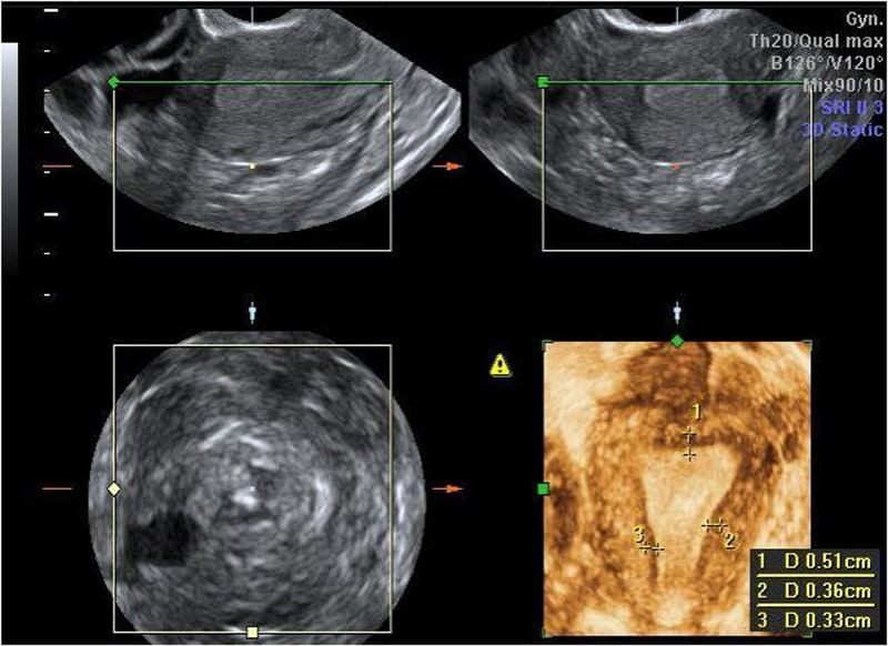 3D pelvic ultrasound scan of the uterus